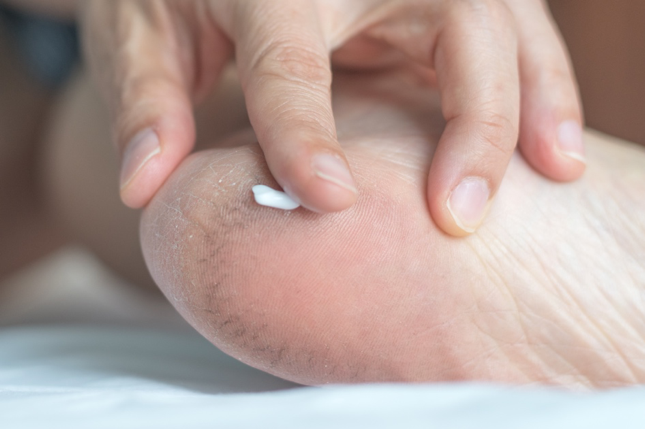 Happy Feet: How To Combat Dry Skin & Cracked Heels - NZ Herald